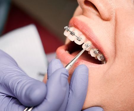 Behel Sebuah Evolusi Alternatif Untuk Perawatan Gigi Modern