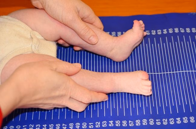 Sindrom Dwarfisme, Seseorang Dengan Tinggi Badan Rendah